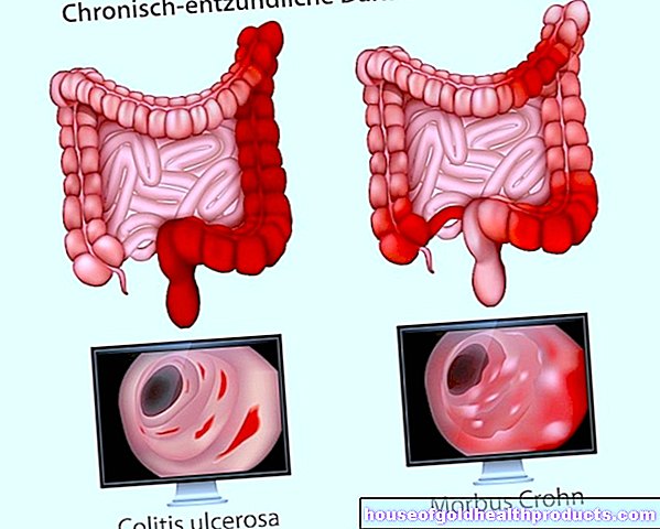 алтернативна медицина - Алтернативна медицина и болест на Crohn / улцерозен колит