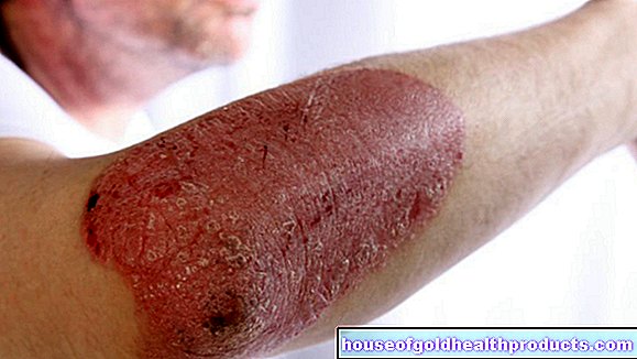 kůže - Kožní choroby
