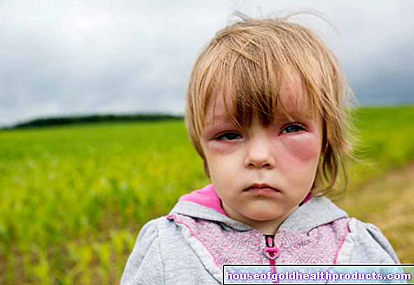 Allergia nei bambini