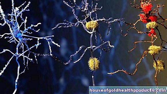 Alzheimer -kór: Az új hatóanyag tisztítja az agyat