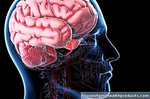 تمدد الأوعية الدموية - الدماغ