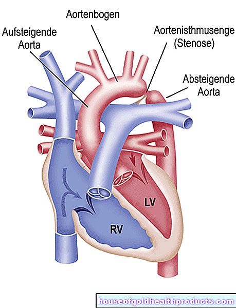 Koarktace aorty