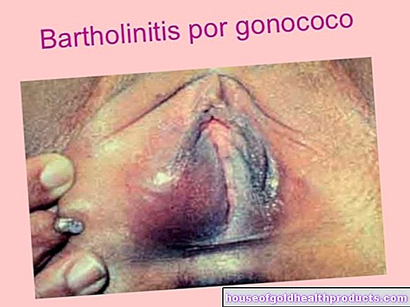 Bartholinitas