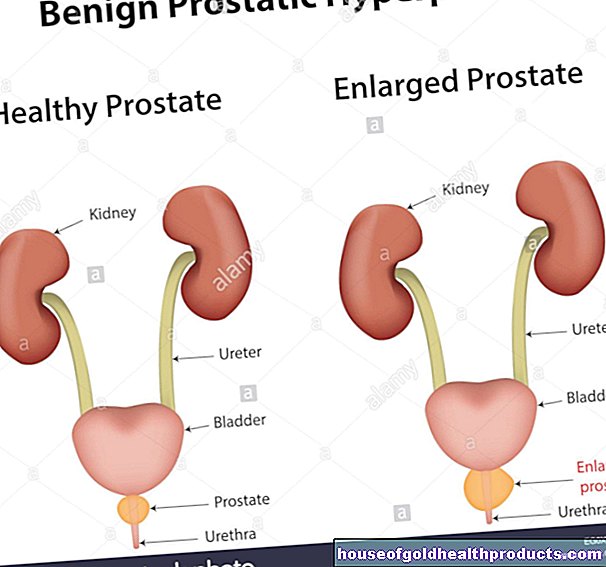 Gerybinė prostatos hiperplazija