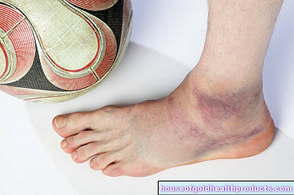 Raztrgan ligament na stopalu