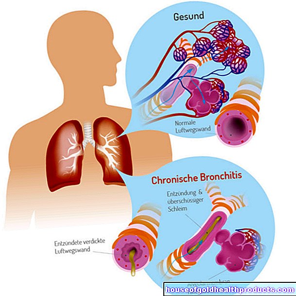 Chronická bronchitída