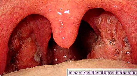 Kronisk tonsillit