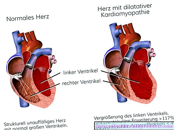 Tágult kardiomiopátia