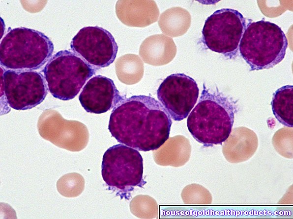 Leucemia a cellule capellute