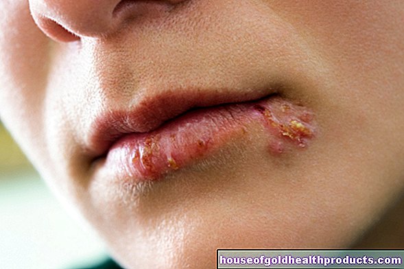 Herpes en la boca