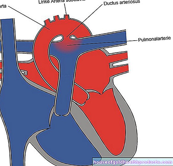 Heart defects (vitien)