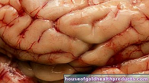Hemorragia cerebral: incluso los aneurismas pequeños a menudo estallan