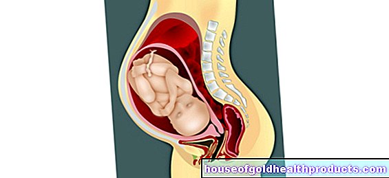 Hemorroides - embarazo