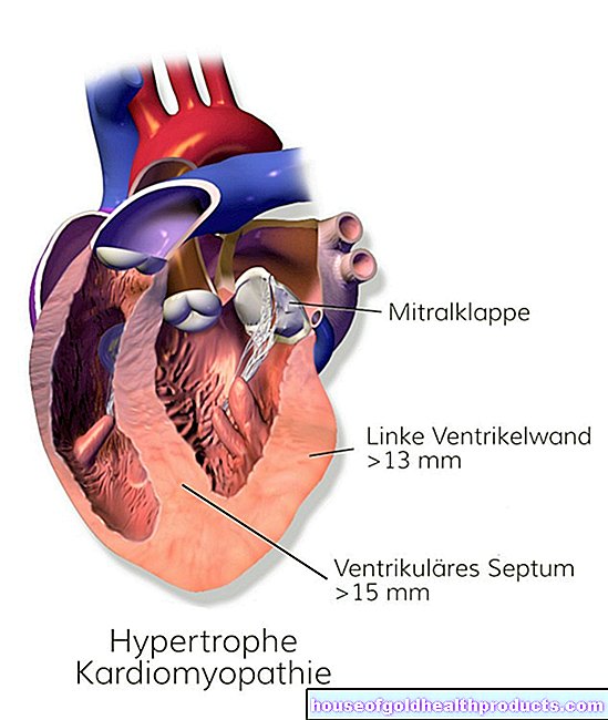 Cardiomiopatie hipertropica