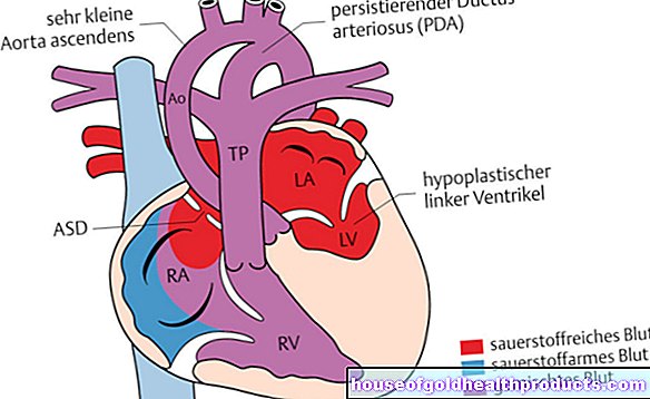 Sindrom jantung kiri hipoplastik