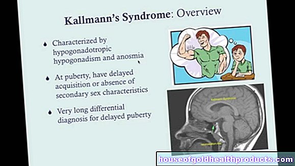 Синдром Каллмана