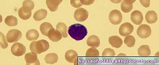 فقر الدم ذو الخلايا الكروية