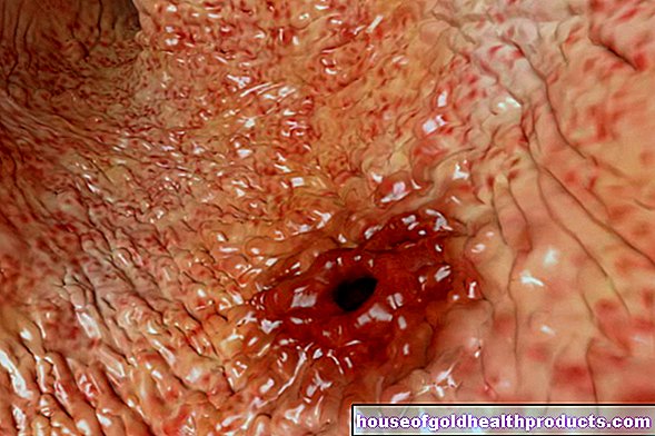 Úlcera estomacal