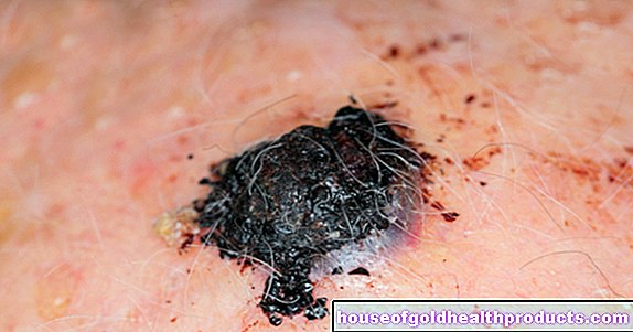 الورم الميلانيني الخبيث (سرطان الجلد الأسود)