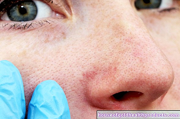 편두통: 코를 통한 통증 차단