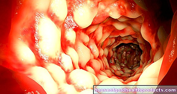 enfermedad de Crohn