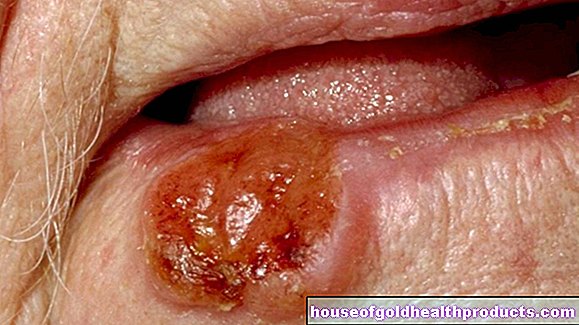 Рак на устната кухина