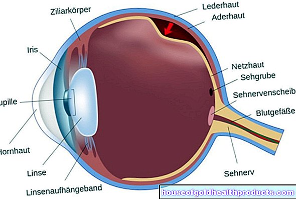 Distacco della retina