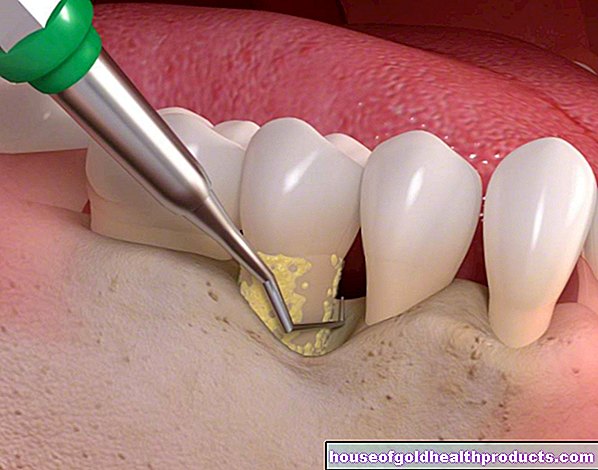 Penyakit periodontal: pengobatan
