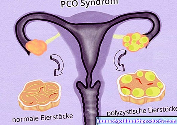 Polycystiskt ovariesyndrom