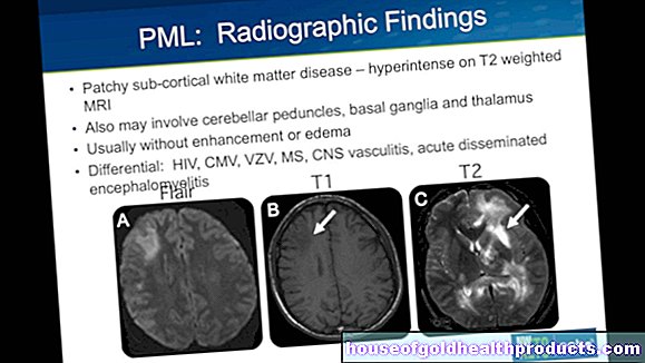 PML (اعتلال بيضاء الدماغ متعدد البؤر التقدمي)