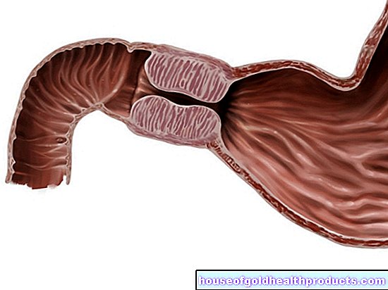 Pylorická stenóza