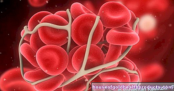 Strok: kekurangan zat besi menyebabkan darah membeku