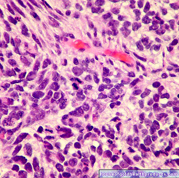 SCLC: Karsinoma paru-paru sel kecil