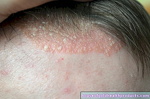 Eczema seboreică