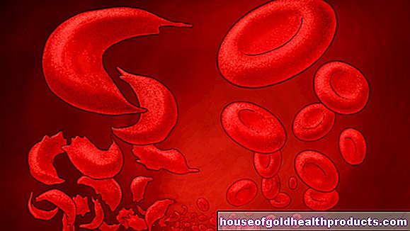 Сърповидно-клетъчна анемия