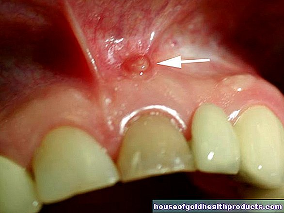 Zubná fistula