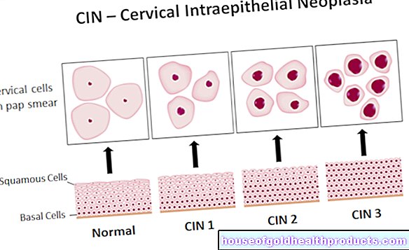 Gimdos kaklelio intraepitelinė neoplazija (CIN)