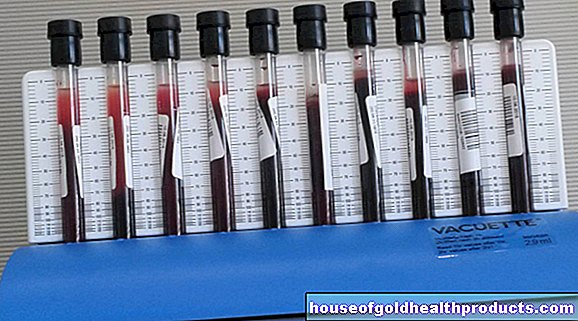 valores de laboratorio - Sedimentación de sangre