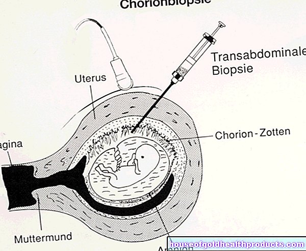 ولادة الحمل - أخذ عينات من خلايا المشيمة