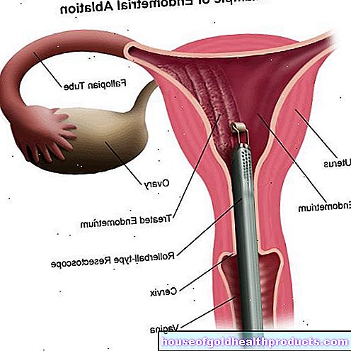 Endometriumo abliacija