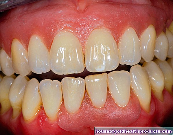 أسنان - أعناق الأسنان الحساسة