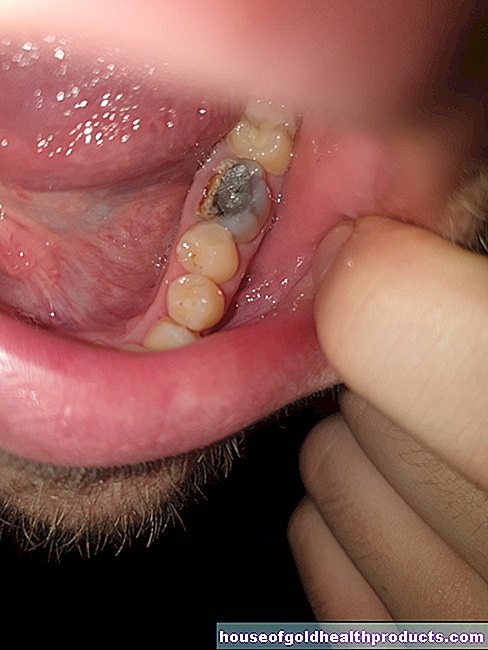 gigi - Gigi patah